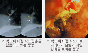 도내시경:식도전층을 침범하고 있는 종양 / 식도내시경:식도내로 자라나와 출혈과 궤양 형태를 보이는 종양