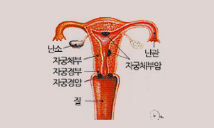 자궁경부암